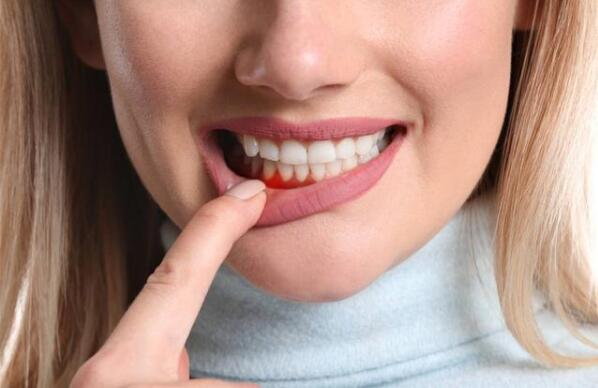 牙龈出血主要是因为这几种原