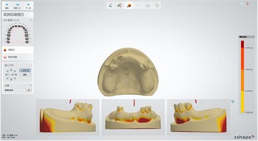 齿科应用 | 黑格科技Cast 2.0材料支架包埋铸造方案实现又一突破