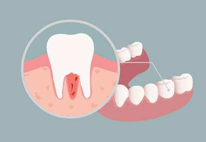 中性粒细胞在牙周炎和糖尿病双向关系中作用的研究进展