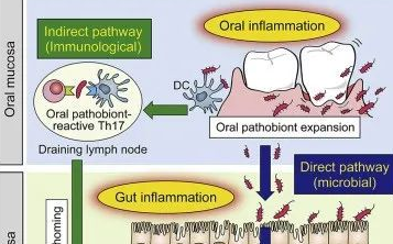 新研究展示口腔细菌加重肠道炎症机制