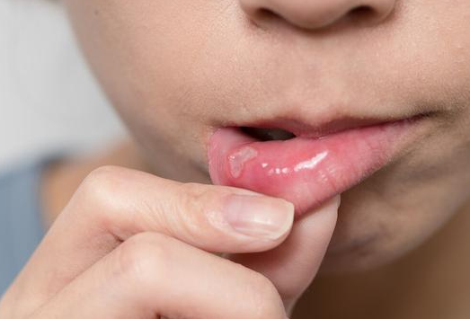 口腔癌“来临”前的4个危险“信号”