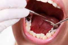 龋齿和蛀牙有何区别，和“虫子”有关么？ 