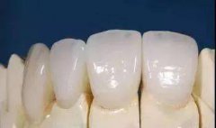 全瓷牙能用多久？有什么优势？ 