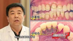 如何预防牙龈炎？