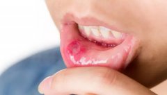 口腔白斑的临床表现，该如何治疗？