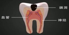 牙齿自发痛、刺激痛……或是急性牙髓炎！！ 