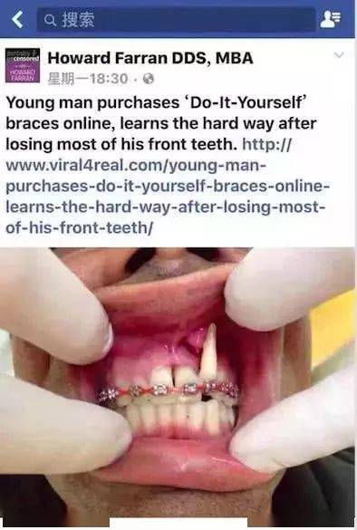 网上的牙齿矫正器真的靠谱吗？有人敢买吗？