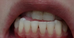 警惕牙龈萎缩，口腔清洁很重要！
