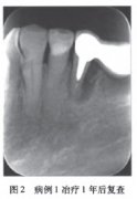 口腔网：牙骨质撕裂的治疗原则