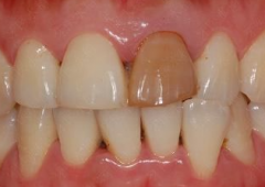 为什么牙髓坏死需要根管治疗？