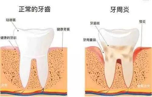 研究发现牙周炎会通过接吻传染