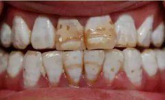 牙齿由内而外发黑变色是什么原因？