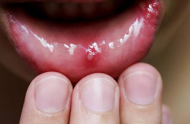 女子反复口腔溃疡确诊舌癌中晚期