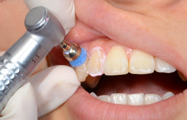 口腔网 ：关于“洗牙”的误区